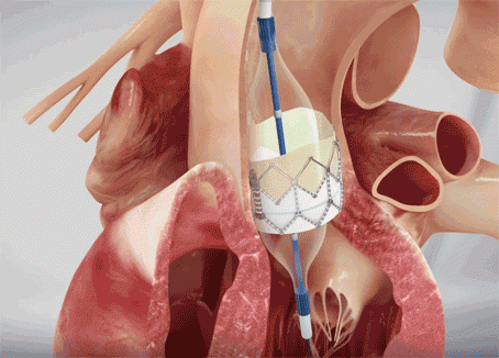 TAVR at a Glance
