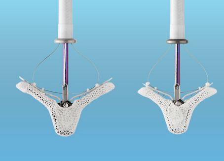 Transcatheter Mitral Valve Replacement (TMVr)